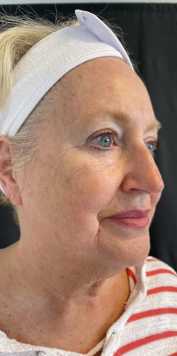 Facelift Before & After Gallery - Patient 50824372 - Image 7
