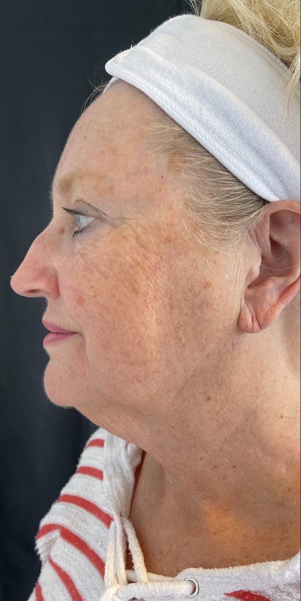 Facelift Before & After Gallery - Patient 50824372 - Image 5