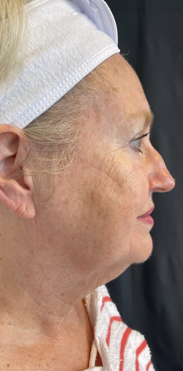 Facelift Before & After Gallery - Patient 50824372 - Image 9