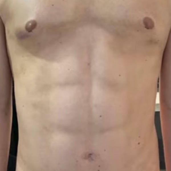 Abdomen Liposuction Before & After Gallery - Patient 146990039 - Image 2