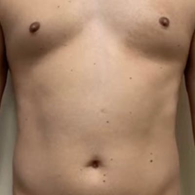 Abdomen Liposuction Before & After Gallery - Patient 146990039 - Image 1