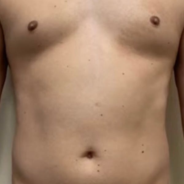 Abdomen Liposuction Before & After Gallery - Patient 146990039 - Image 1