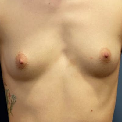 Breast Augmentation Before & After Gallery - Patient 57582661 - Image 1