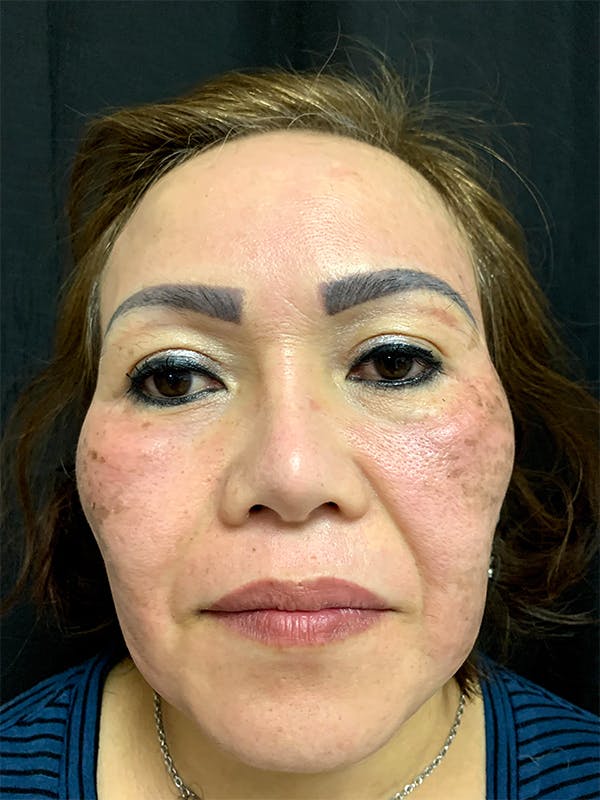 PicoWay Before & After Gallery - Patient 57583573 - Image 1