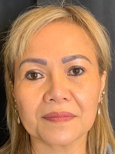 PicoWay Before & After Gallery - Patient 57583573 - Image 2