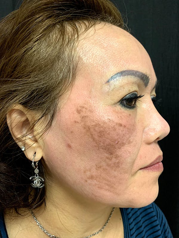 PicoWay Before & After Gallery - Patient 57583573 - Image 3