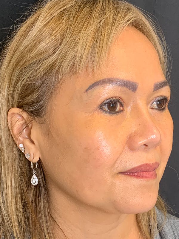 PicoWay Before & After Gallery - Patient 57583573 - Image 4