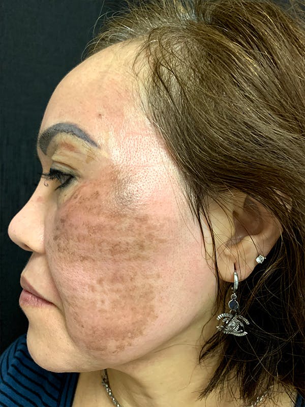 PicoWay Before & After Gallery - Patient 57583573 - Image 5