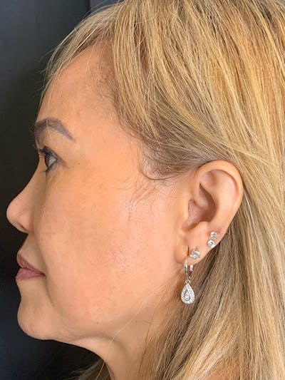 PicoWay Before & After Gallery - Patient 57583573 - Image 6