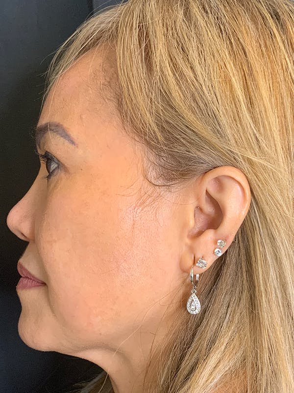 PicoWay Before & After Gallery - Patient 57583573 - Image 6