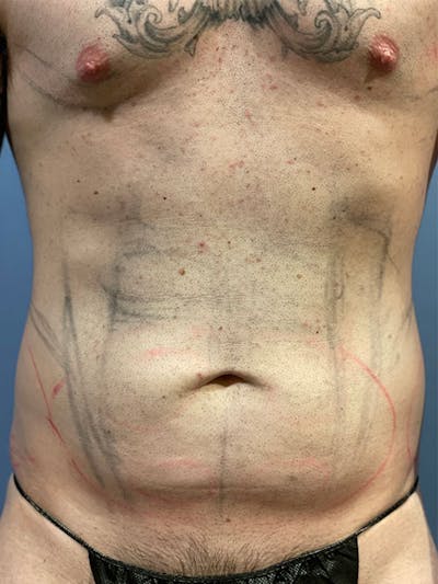 Abdomen Liposuction Before & After Gallery - Patient 146990014 - Image 1