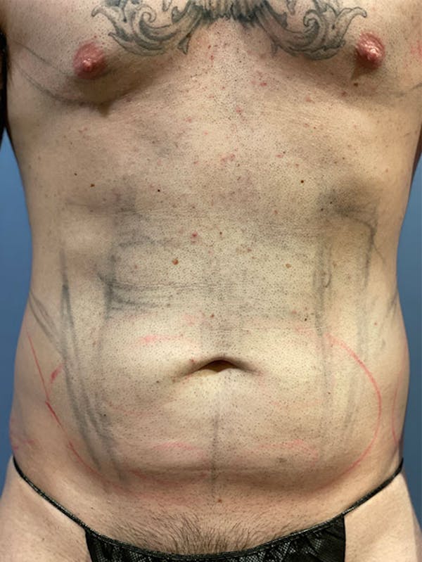Liposuction Gallery - Patient 91507280 - Image 1