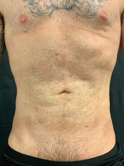 Abdomen Liposuction Before & After Gallery - Patient 146990014 - Image 2