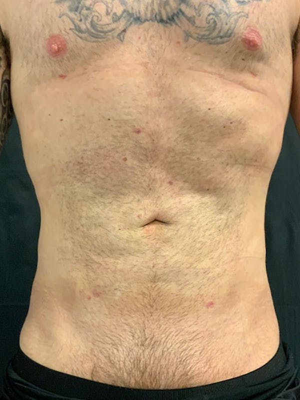 Abdomen Liposuction Before & After Gallery - Patient 146990014 - Image 2