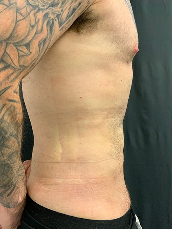 Abdomen Liposuction Before & After Gallery - Patient 146990014 - Image 4