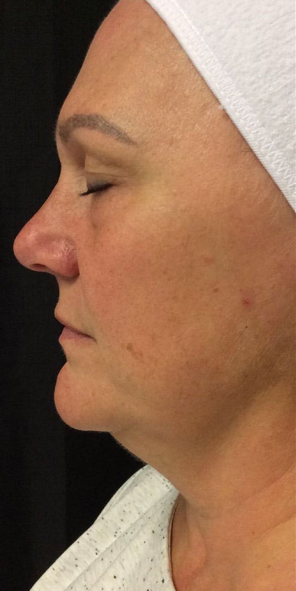 Facelift Before & After Gallery - Patient 91507295 - Image 1