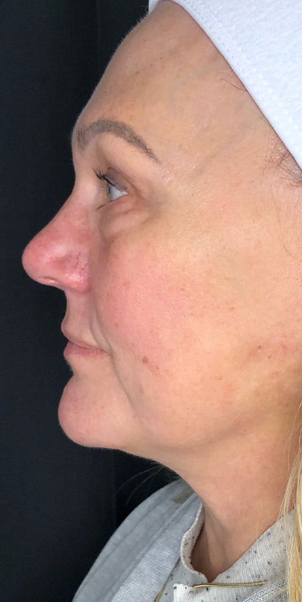 Facelift Before & After Gallery - Patient 91507295 - Image 2