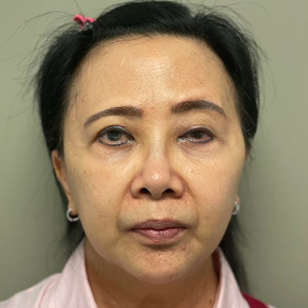 Facelift Before & After Gallery - Patient 105214235 - Image 1