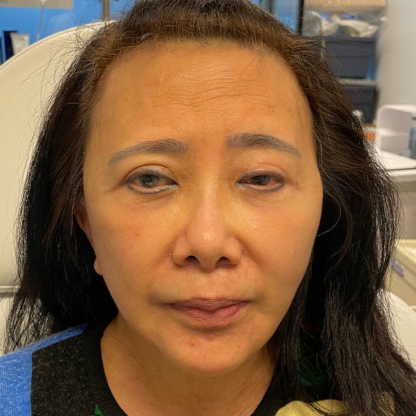 Facelift Before & After Gallery - Patient 105214235 - Image 2