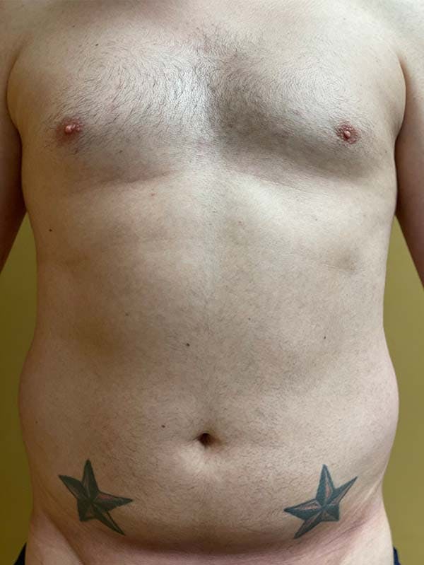 Liposuction Before & After Gallery - Patient 122343224 - Image 1