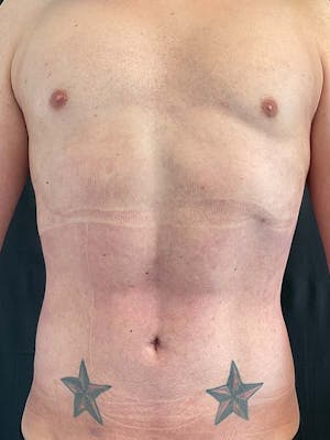 Liposuction
