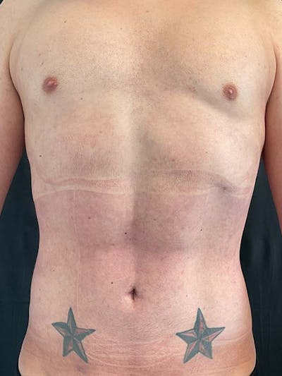 Liposuction Gallery - Patient 122343224 - Image 2