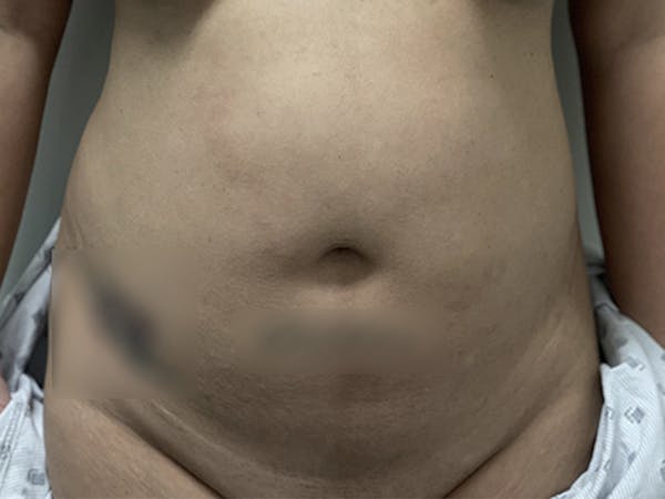Abdomen Liposuction Before & After Gallery - Patient 146990017 - Image 1