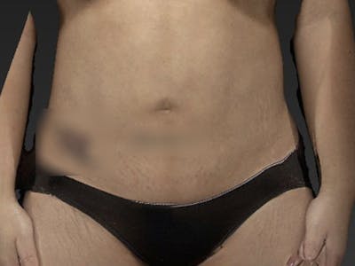 Abdomen Liposuction Before & After Gallery - Patient 146990017 - Image 2