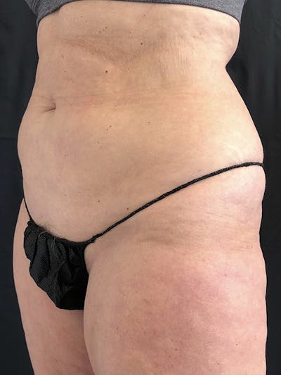Abdomen Liposuction Before & After Gallery - Patient 146990018 - Image 1