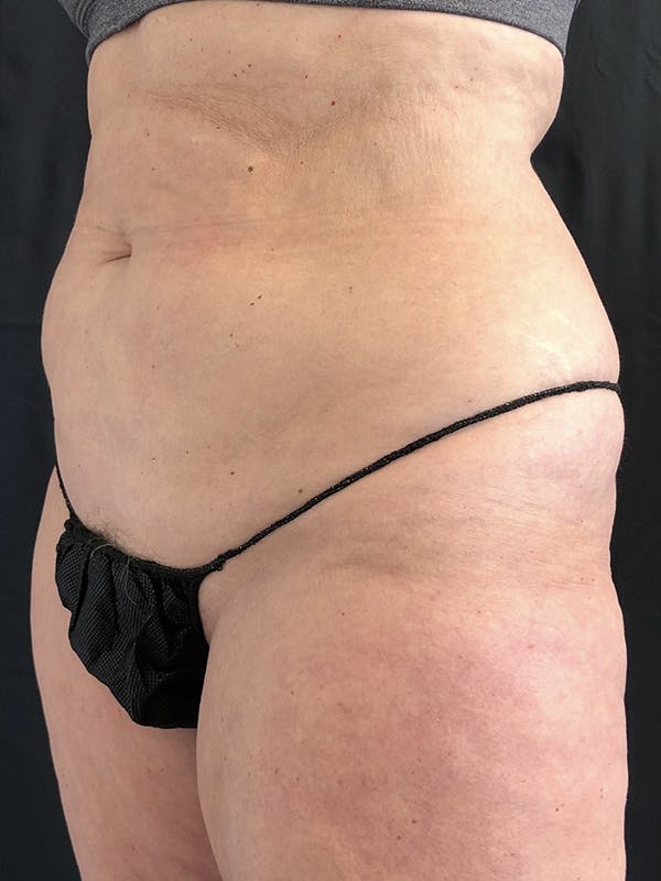 Abdomen Liposuction Before & After Gallery - Patient 146990018 - Image 1