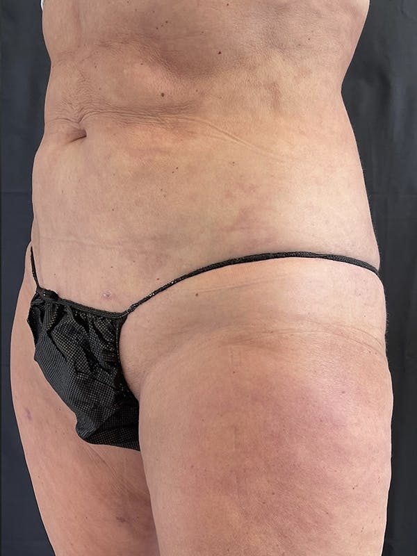 Abdomen Liposuction Before & After Gallery - Patient 146990018 - Image 2