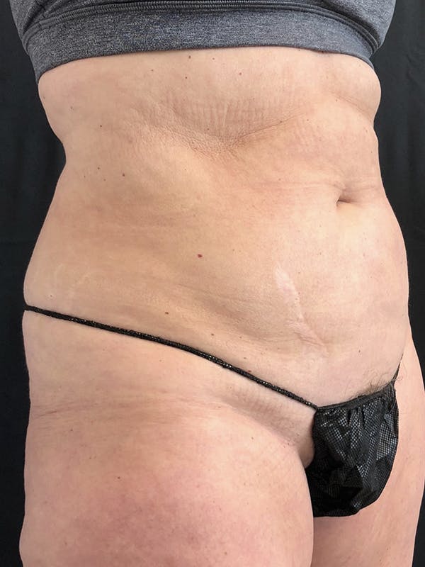 Liposuction Before & After Gallery - Patient 122404121 - Image 3