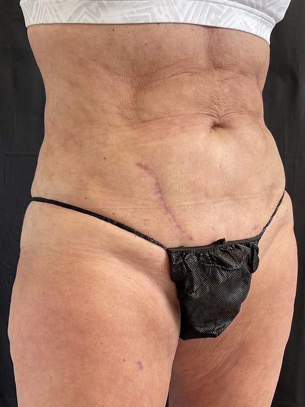 Liposuction Before & After Gallery - Patient 122404121 - Image 4