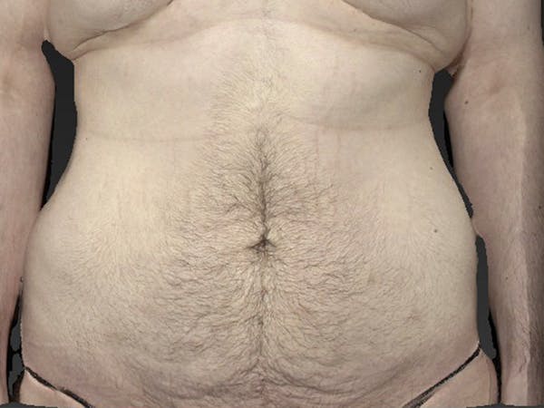 Liposuction Before & After Gallery - Patient 122404124 - Image 1