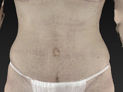 Abdomen Liposuction Before & After Gallery - Patient 146990052 - Image 2