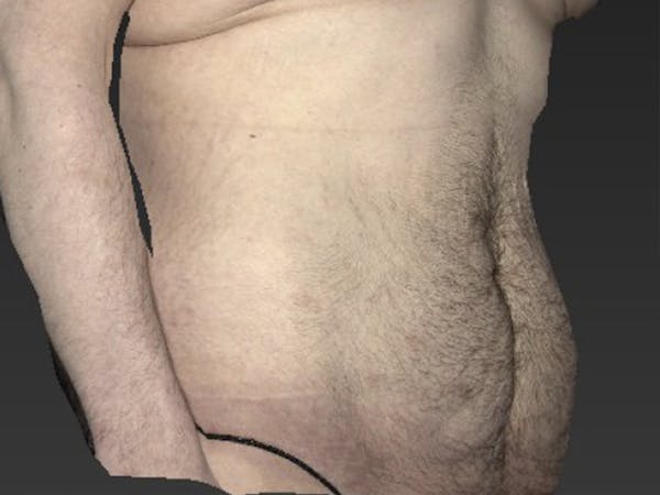 Abdomen Liposuction Before & After Gallery - Patient 146990052 - Image 3