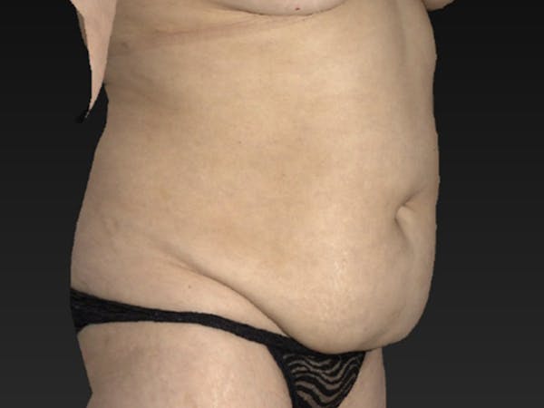 Liposuction Gallery - Patient 122404122 - Image 1