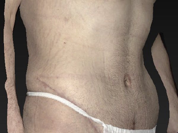 Liposuction Before & After Gallery - Patient 122404124 - Image 4