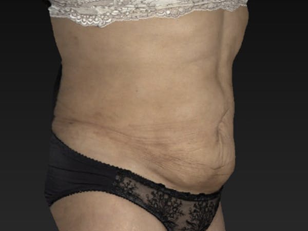 Liposuction Before & After Gallery - Patient 122404122 - Image 2