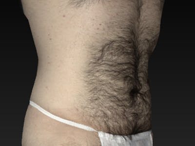 Abdomen Liposuction Before & After Gallery - Patient 146990020 - Image 1