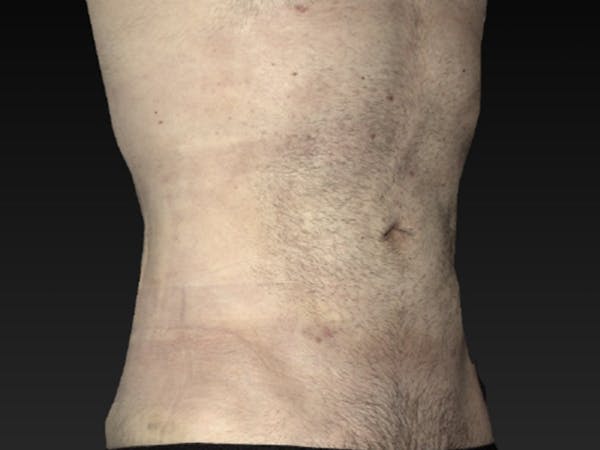 Abdomen Liposuction Before & After Gallery - Patient 146990020 - Image 2