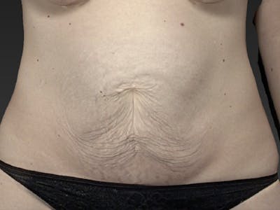 Abdomen Liposuction Before & After Gallery - Patient 146990025 - Image 1