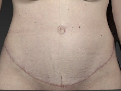 Abdomen Liposuction Before & After Gallery - Patient 146990025 - Image 2