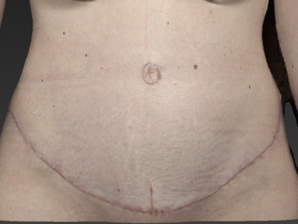 Abdomen Liposuction Before & After Gallery - Patient 146990025 - Image 2