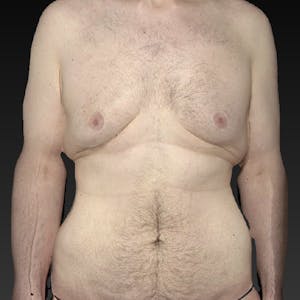 Tummy Tuck