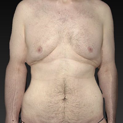 Tummy Tuck (Abdominoplasty)  Before & After Gallery - Patient 122404144 - Image 1