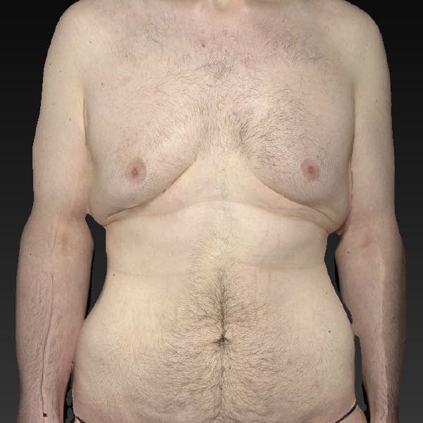 Tummy Tuck Before & After Gallery - Patient 122404144 - Image 1
