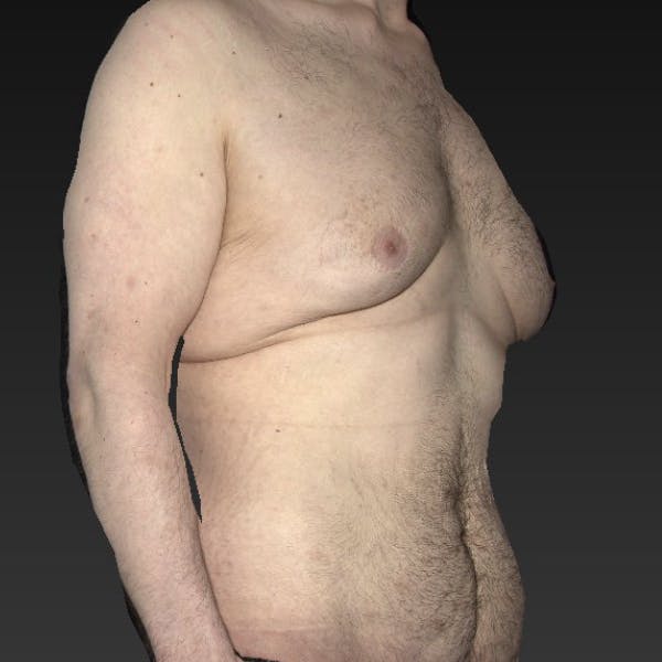  Gynecomastia Before & After Gallery - Patient 122404140 - Image 3