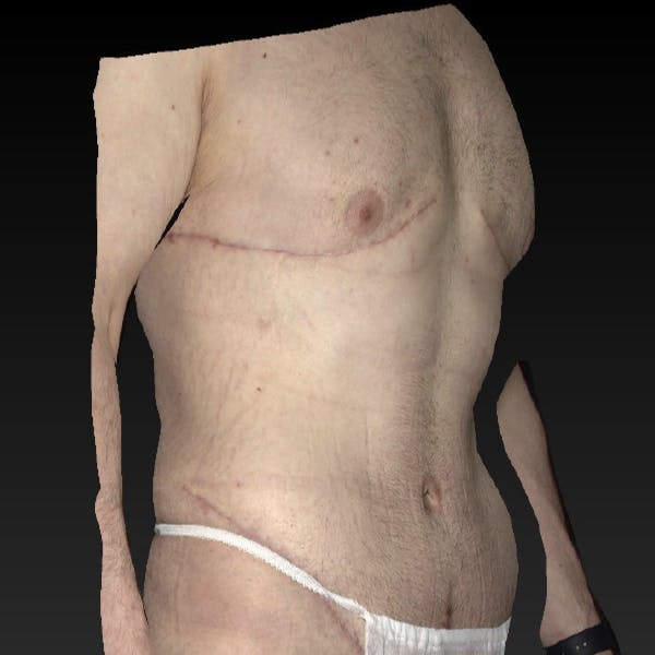 Tummy Tuck Gallery - Patient 122404144 - Image 4