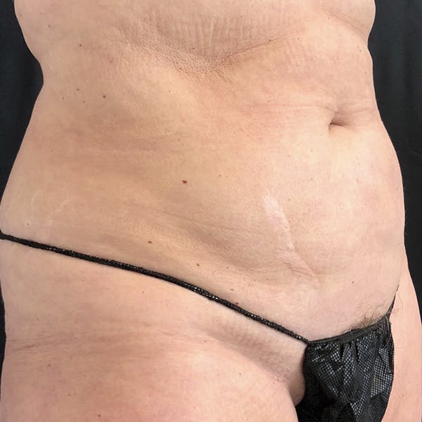  Scar Revision Before & After Gallery - Patient 122404176 - Image 1